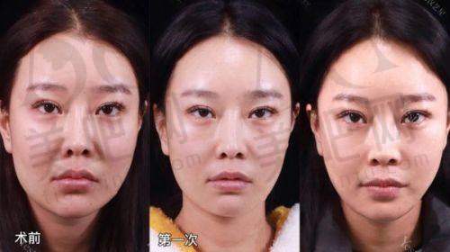 成都美雅娜佳人医疗美容门诊部靠谱吗？廖连平医生20年经验做鼻修复实例多风格自然