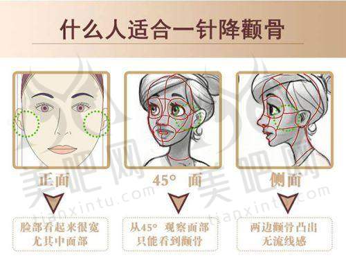 双眼皮手术成效实例