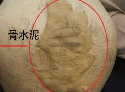 胸部整形项目