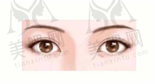埋线双眼皮