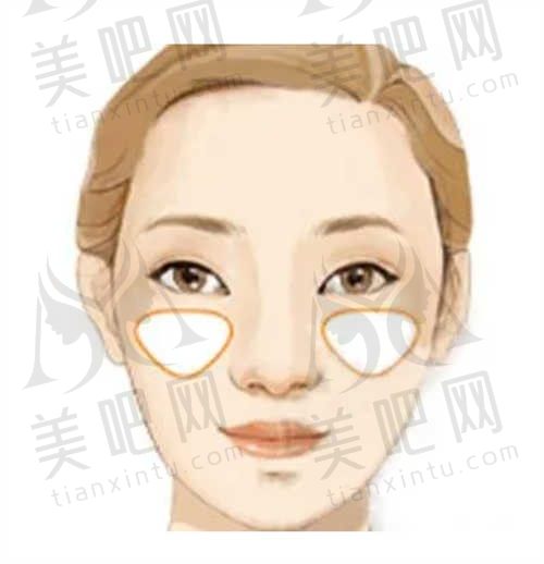 玻尿酸丰苹果肌