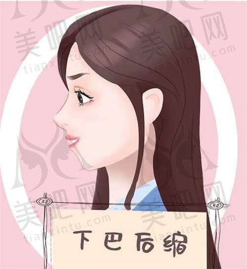 下巴吸脂