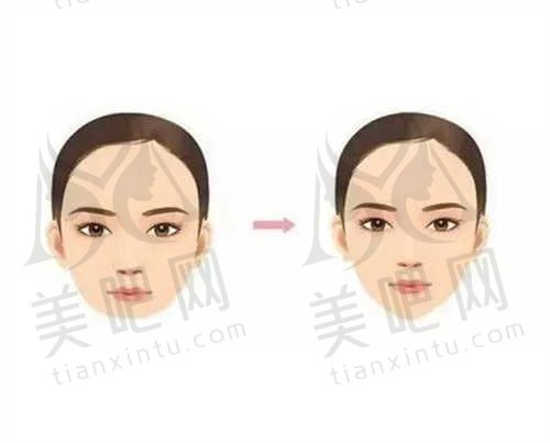 激光溶脂减双下巴