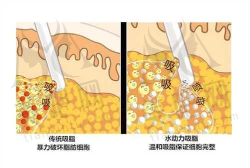 吸脂瘦小腿