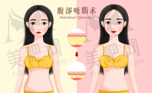 吸脂瘦腰腹