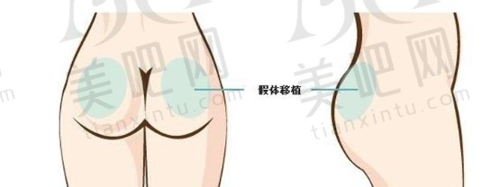 假体丰臀