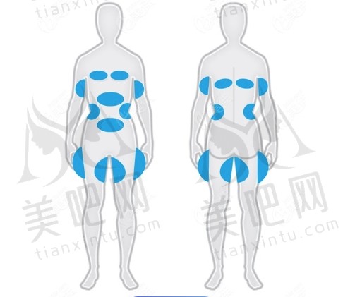 冷冻溶脂瘦大腿