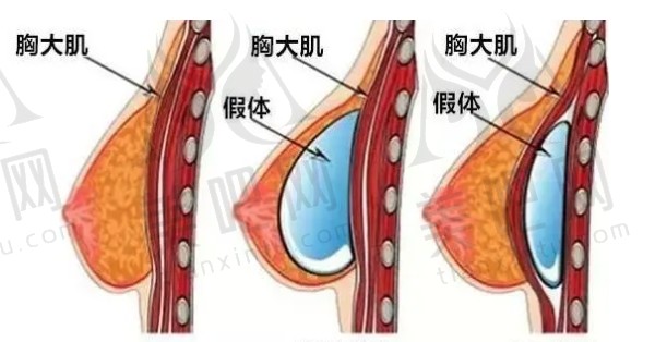 假体隆胸