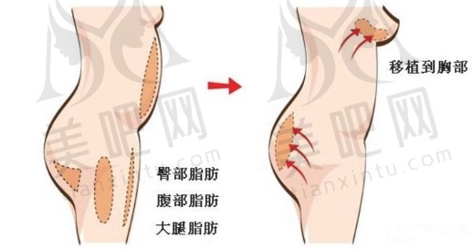 自体脂肪隆胸