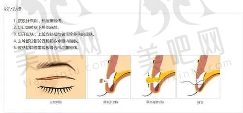 开外眼角