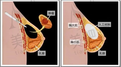 巨乳缩小失败修复