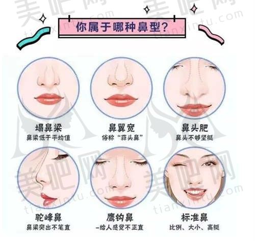 玻尿酸注射隆鼻