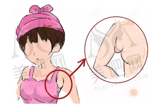 吸脂去副乳